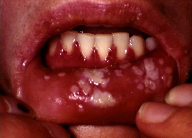 Description: Image result for herpes gingivostomatitis